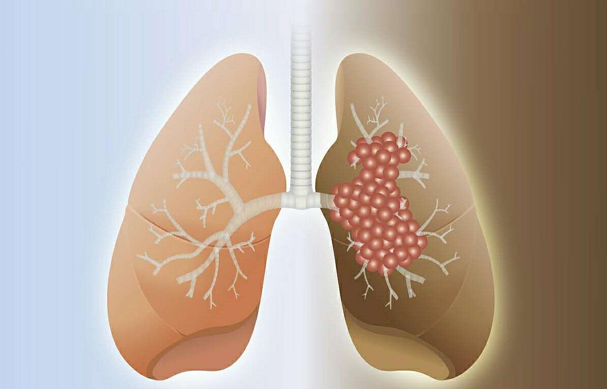 肺癌图片早期症状图片